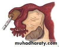 Ectopic pregnancy