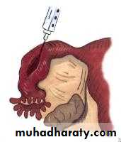 Ectopic pregnancy