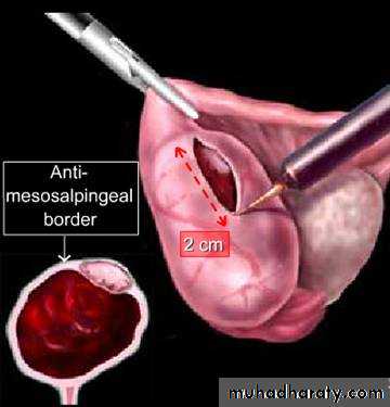 Ectopic pregnancy
