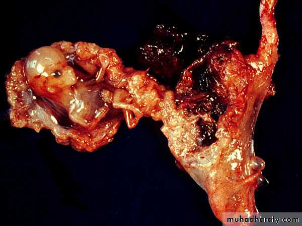 Ectopic pregnancy