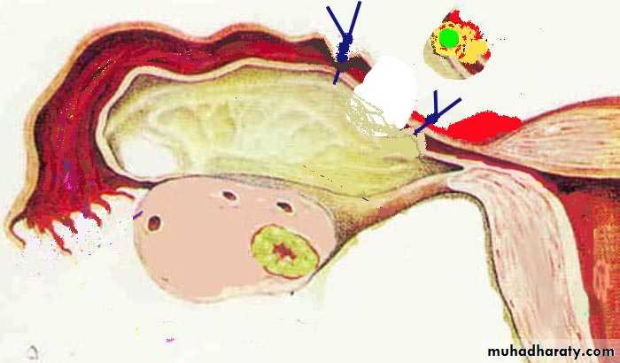 Ectopic pregnancy