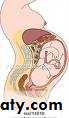 Ectopic pregnancy