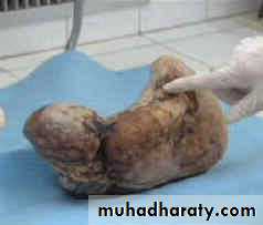 Ectopic pregnancy