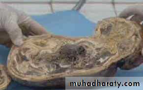 Ectopic pregnancy