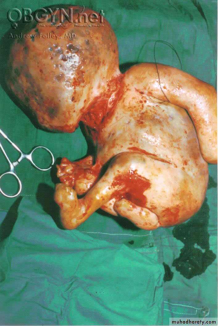 Ectopic pregnancy