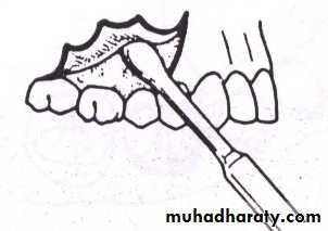 Impaction