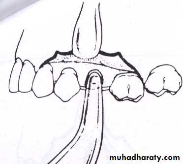 Impaction