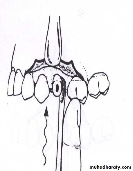 Impaction