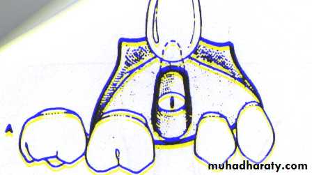 Impaction