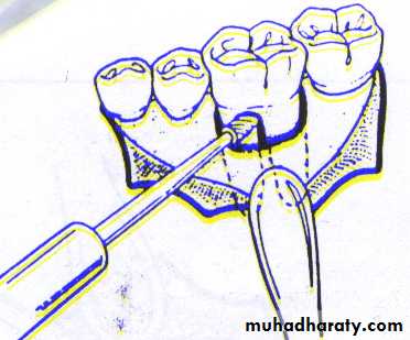 Impaction