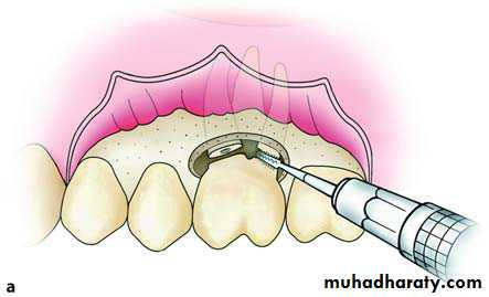 Impaction