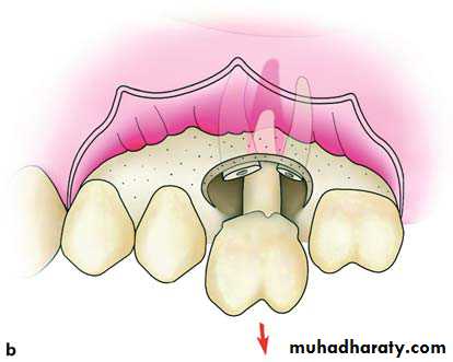 Impaction