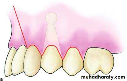Impaction