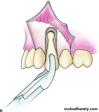 Impaction