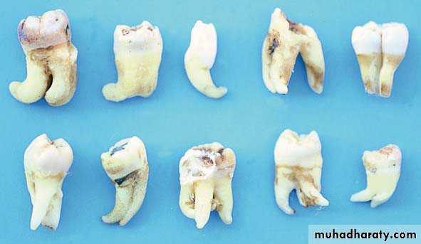 Impaction