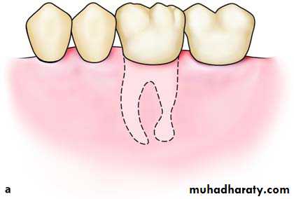 Impaction