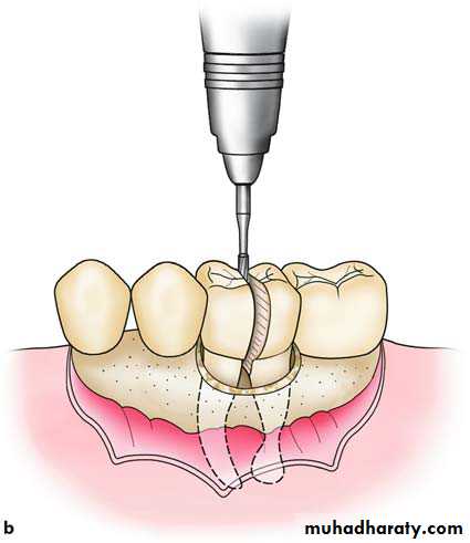 Impaction