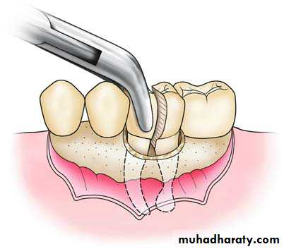 Impaction