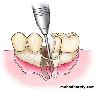 Impaction