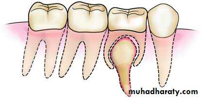 Impaction