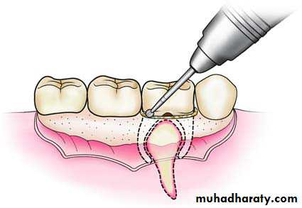 Impaction