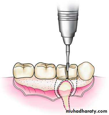 Impaction