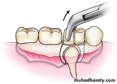 Impaction