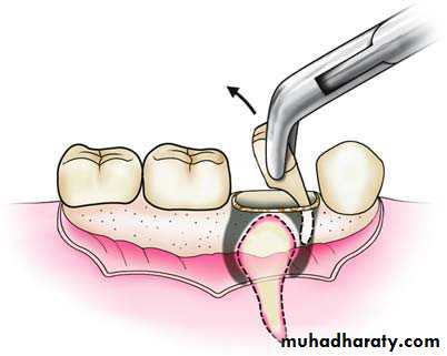 Impaction