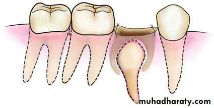 Impaction