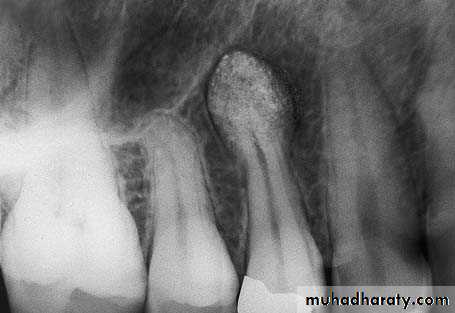Impaction