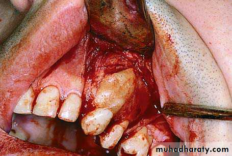 Impaction