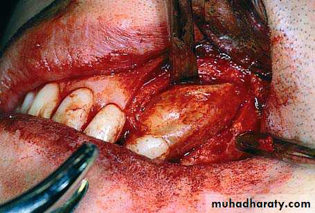 Impaction