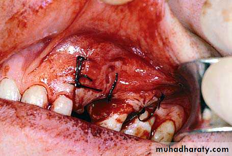 Impaction