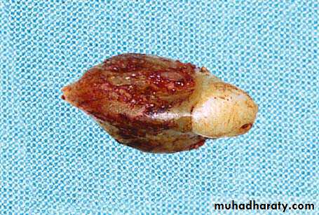 Impaction