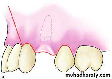 Impaction
