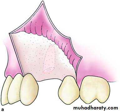 Impaction