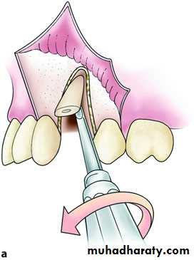Impaction