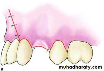 Impaction