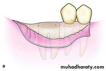 Impaction