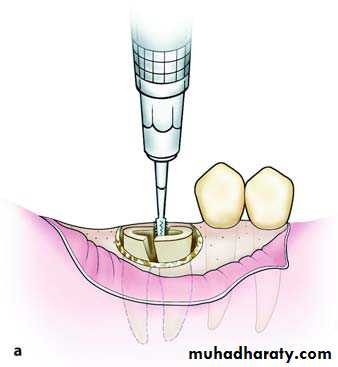 Impaction