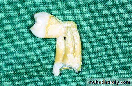 Impaction