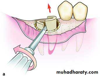 Impaction