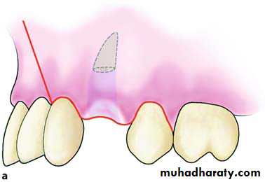 Impaction