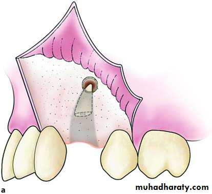 Impaction