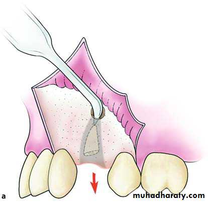 Impaction