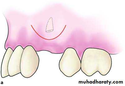 Impaction