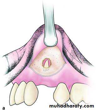 Impaction
