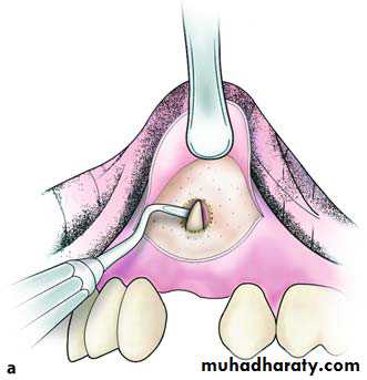 Impaction