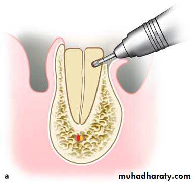 Impaction