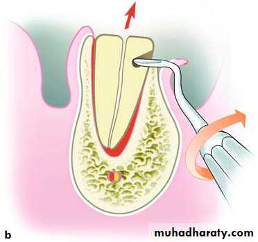 Impaction